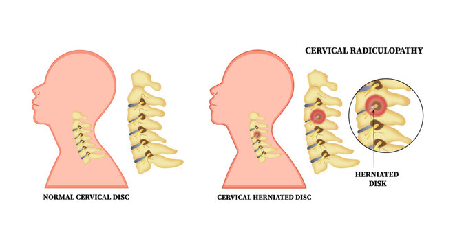 Herniation Bone Disk Neck Thoracic Outlet Syndrome Vector Illustration