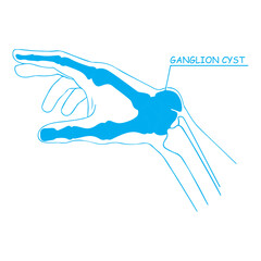 Ganglion Cyst