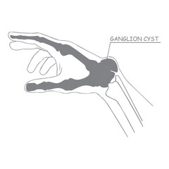 Obraz premium Ganglion Cyst Diagram