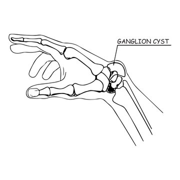 Ganglion Cyst Diagram