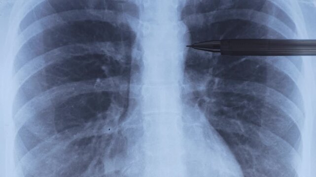 Doctor learning x-ray with tumor on the spine. 