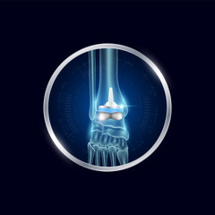 Artificial joints in circle frame label aluminum. Ankle replacement or Prosthetic implant. Orthopedic technology surgery for treatment arthritis damaged cartilage. Medical product vector.