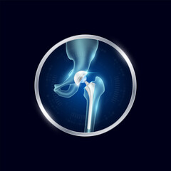 Artificial joints in circle frame label aluminum. Hip replacement or Prosthetic implant. Orthopedic technology surgery for treatment arthritis damaged cartilage. Medical product vector.