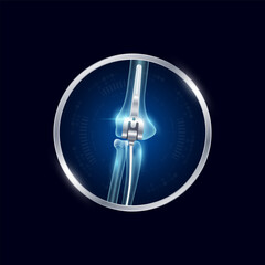 Artificial joints in circle frame label aluminum. Elbow replacement or Prosthetic implant. Orthopedic technology surgery for treatment arthritis damaged cartilage. Medical product vector.