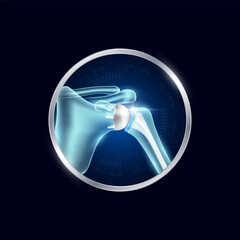Artificial joints in circle frame label aluminum. Shoulder replacement or Prosthetic implant. Orthopedic technology surgery for treatment arthritis damaged cartilage. Medical product vector.