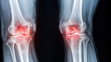 disease, joints, pain, inflammation, arthrosis, arthritis, x-ray, examination