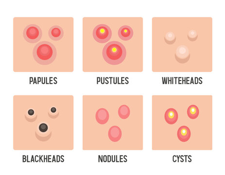 Acne. Types of acne. Papules, pustules, cysts, blackheads, etc. Vector illustration