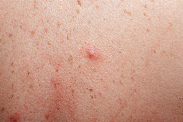 Fototapeta premium Macro shot of human skin with inflammation and pimples.