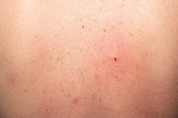 Fototapeta premium Close-up of skin with inflammation, redness and small bleeding wound.