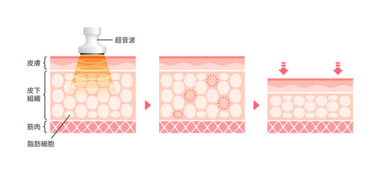 キャビテーションの仕組みと効果　皮膚断面図イラスト / 美容・ダイエット