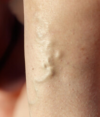 Fototapeta premium The leg of a person with a visible vein