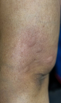 skin allergy showing severe irritation and redness from bug bite or insect sting