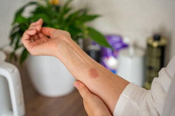 Close up view of scald burn on a hand caused by steam from a kettle in a kitchen. Domestic accident...