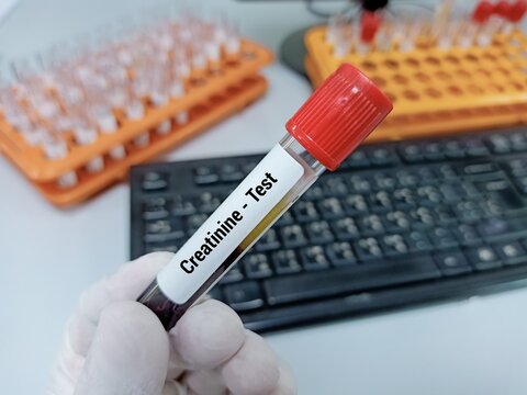 Doctor  holding a test blood sample for Creatinine - test. Laboratory medical testing concept. . 