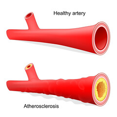 Atherosclerosis. Healthy artery with normal blood flow and blood vessel with Arteriosclerotic vascular disease that have accumulated cholesterol in wall, and abnormal blood flow. 