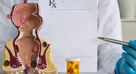 Doctor model of the rectum with inflamed vascular structures and pills