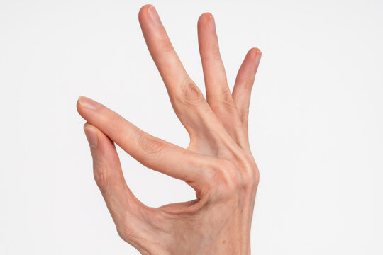Close up of human hand with hypermobile finger showing sign of Marfan syndrome. Abnormal joint flexibility test for medical documentation, isolated on white background