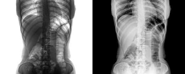 X-Ray of Abdomen in Anterior View Depicting Internal Organs and Skeletal Framework for Abdominal Pain Evaluation Isolated on Transparent or White Background