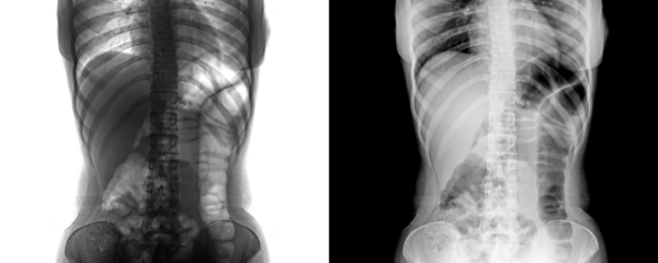 X-Ray of Abdomen in Anterior View Depicting Internal Organs and Skeletal Framework for Abdominal Pain Evaluation Isolated on Transparent or White Background