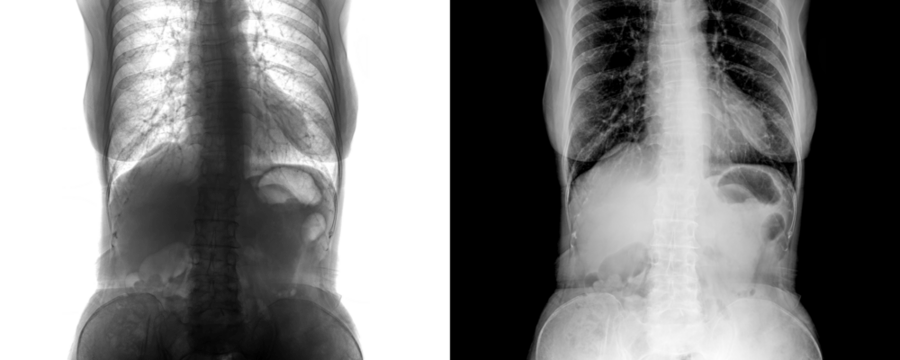 Medical Radiograph of Abdomen Anterior View Demonstrating Abdominal Structures and Bone Anatomy for Pain Detection Isolated on Transparent or White Background