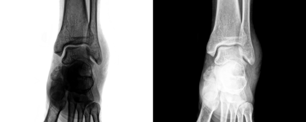Medical X-Ray of Ankle Joint Anterior View Demonstrating Skeletal Structure and Bone Framework for Fracture Detection Isolated on Transparent or White Background 