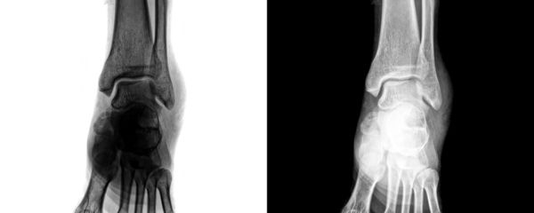 Anterior Projection X-Ray of Human Ankle Joint Showing Bone Anatomy and Skeletal Framework for Fracture Assessment Isolated on Transparent or White Background