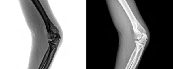 X-Ray of Elbow Lateral View Demonstrating Bone Anatomy and Joint Alignment for Fracture Detection Isolated on Transparent or White Background for Orthopedic and Anatomy Purpose