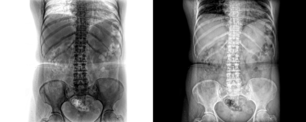 Anterior View Lumbar Spine X-Ray of Skeletal Anatomy for Lower Back Pain Diagnosis for Medical Use Isolated on a Transparent or White Background