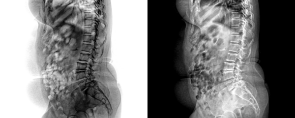 X-Ray of Lumbar Spine in Lateral View of Vertebral Alignment and Skeletal for Lower Back Pain Isolated on a Transparent or White Background