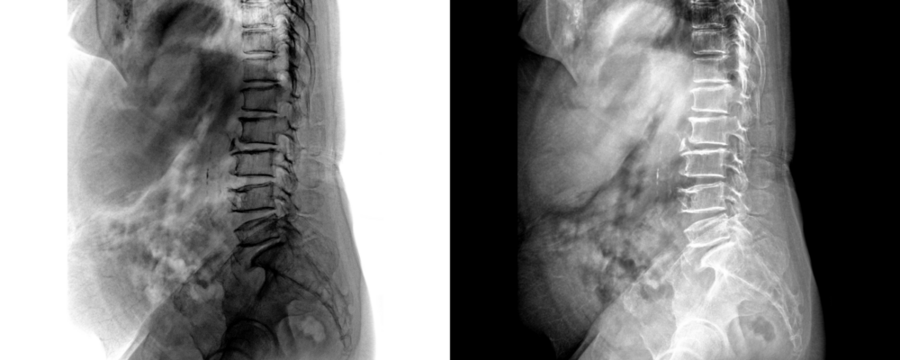 Medical Radiograph of Lumbar Spine Lateral View Demonstrating Vertebral Anatomy for Lower Back Pain Isolated on a Transparent or White Background