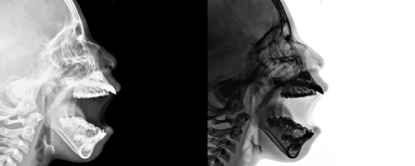 Lateral View Nasopharynx X-Ray of Airway and Adenoid Enlargement for Chronic Adenoiditis Isolated on a Transparent or White Background