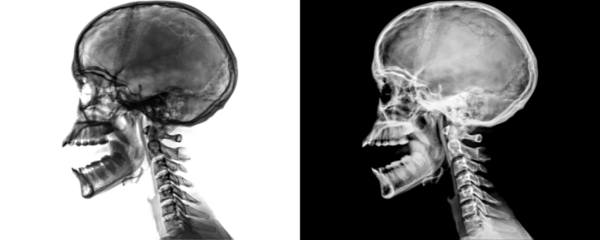 X-Ray of Neck Lateral View Demonstrating Cervical Spine Alignment and Soft Tissue Structures Isolated on a Transparent or White Background