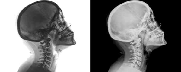 X-Ray of Human Neck in Lateral Projection X-Ray Showing Cervical Spine and Soft Tissue Structures Isolated on a Transparent or White Background