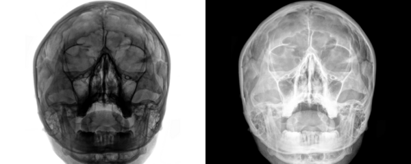 X-Ray of PNS Posteroanterior View Demonstrating Frontal and Nasal Sinus Cavities for Diagnostic Isolated on a Transparent or White Background