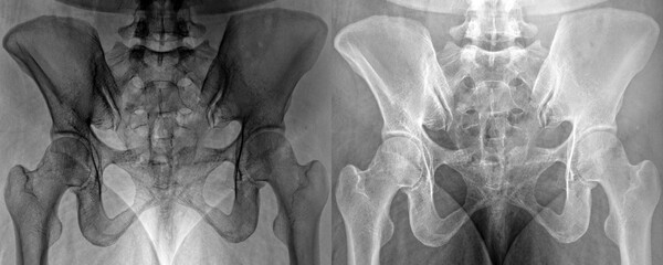 Sacroiliac Joint Anterior View X-Ray of Pelvic Bone Alignment for Diagnosis Isolated on a...