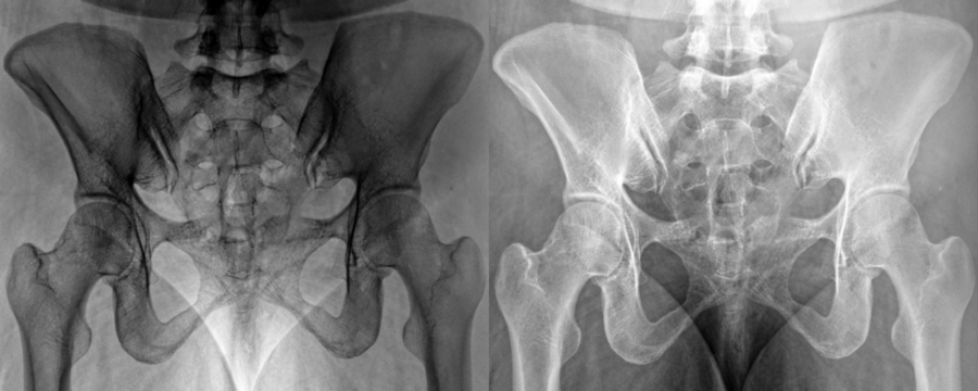 Sacroiliac Joint Anterior View X-Ray of Pelvic Bone Alignment for Diagnosis Isolated on a Transparent or White Background
