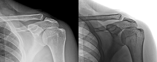 X-Ray of Shoulder Anterior View Demonstrating Joint Alignment for Muscle or Tendon Examination...