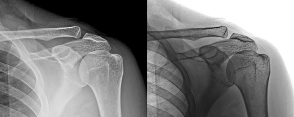 X-Ray of Shoulder Anterior View Demonstrating Joint Alignment for Muscle or Tendon Examination Isolated on a Transparent or White Background