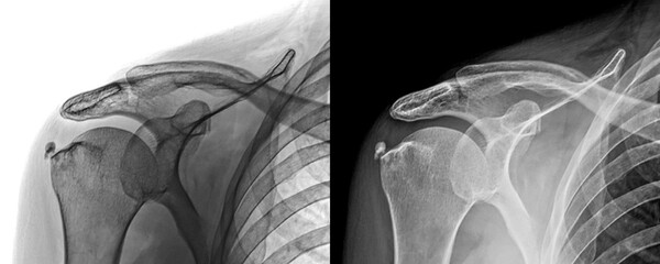 Anterior Projection X-Ray of Shoulder Showing Bone Structure and Joint Space for Prognosis of...