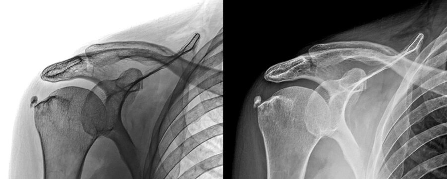 Anterior Projection X-Ray of Shoulder Showing Bone Structure and Joint Space for Prognosis of Injury Isolated on a Transparent or White Background
