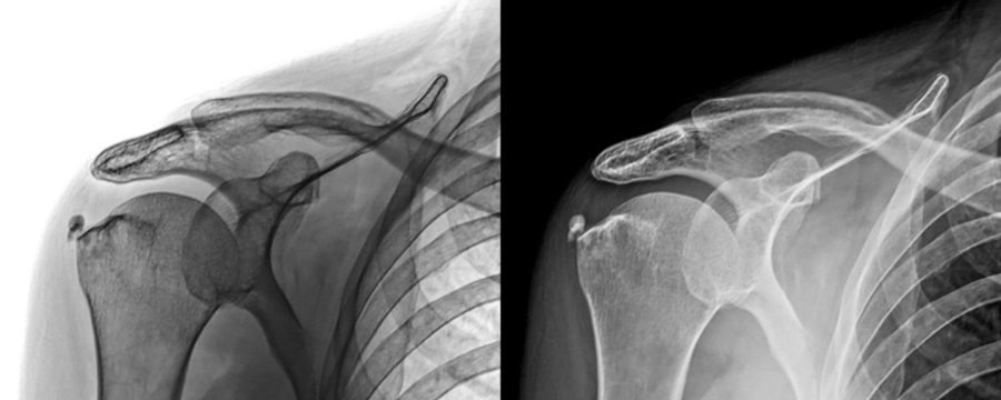 Anterior Projection X-Ray of Shoulder Showing Bone Structure and Joint Space for Prognosis of Injury Isolated on a Transparent or White Background