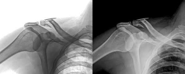 Shoulder Lateral View X-Ray of Bone and Joint Anatomy for Injury Prediction and Muscle Evaluation...