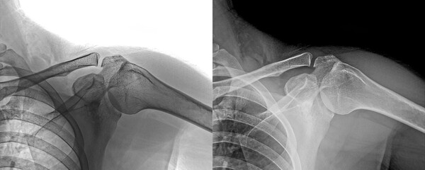 X-Ray of Shoulder in Lateral View of Humeral Head and Glenoid Cavity for Degenerative Diseases...