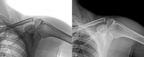 X-Ray of Shoulder in Lateral View of Humeral Head and Glenoid Cavity for Degenerative Diseases Isolated on a Transparent or White Background