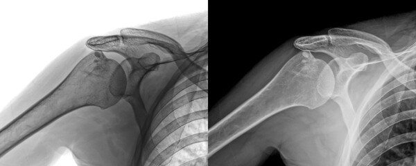 X-Ray of Shoulder Lateral View of Joint Alignment for Diagnosis of Muscle or Tendon Examination...