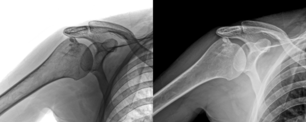 X-Ray of Shoulder Lateral View of Joint Alignment for Diagnosis of Muscle or Tendon Examination Isolated on a Transparent or White Background