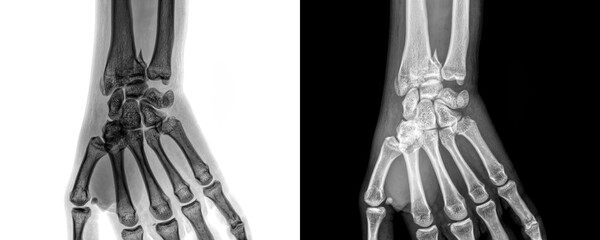 Wrist Joint Anterior View X-Ray Showing Carpal Bones and Joint Alignment for Diagnosis of Fractures...