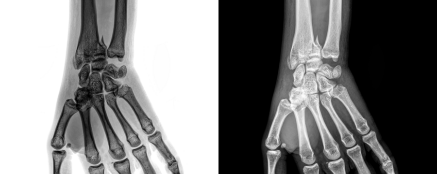 Wrist Joint Anterior View X-Ray Showing Carpal Bones and Joint Alignment for Diagnosis of Fractures Isolated on a Transparent or White Background