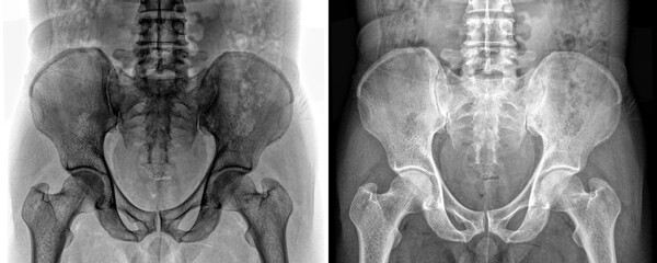 Pelvis Anterior View X-Ray Showing Hip and Pelvic Bone Anatomy for Pain Evaluation and Diagnosis...