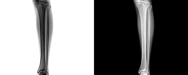 Leg Anterior View X-Ray Showing Tibia and Fibula Bone Alignment for Detecting Fractures and Pre-Surgical Planning Isolated on a Transparent Background.